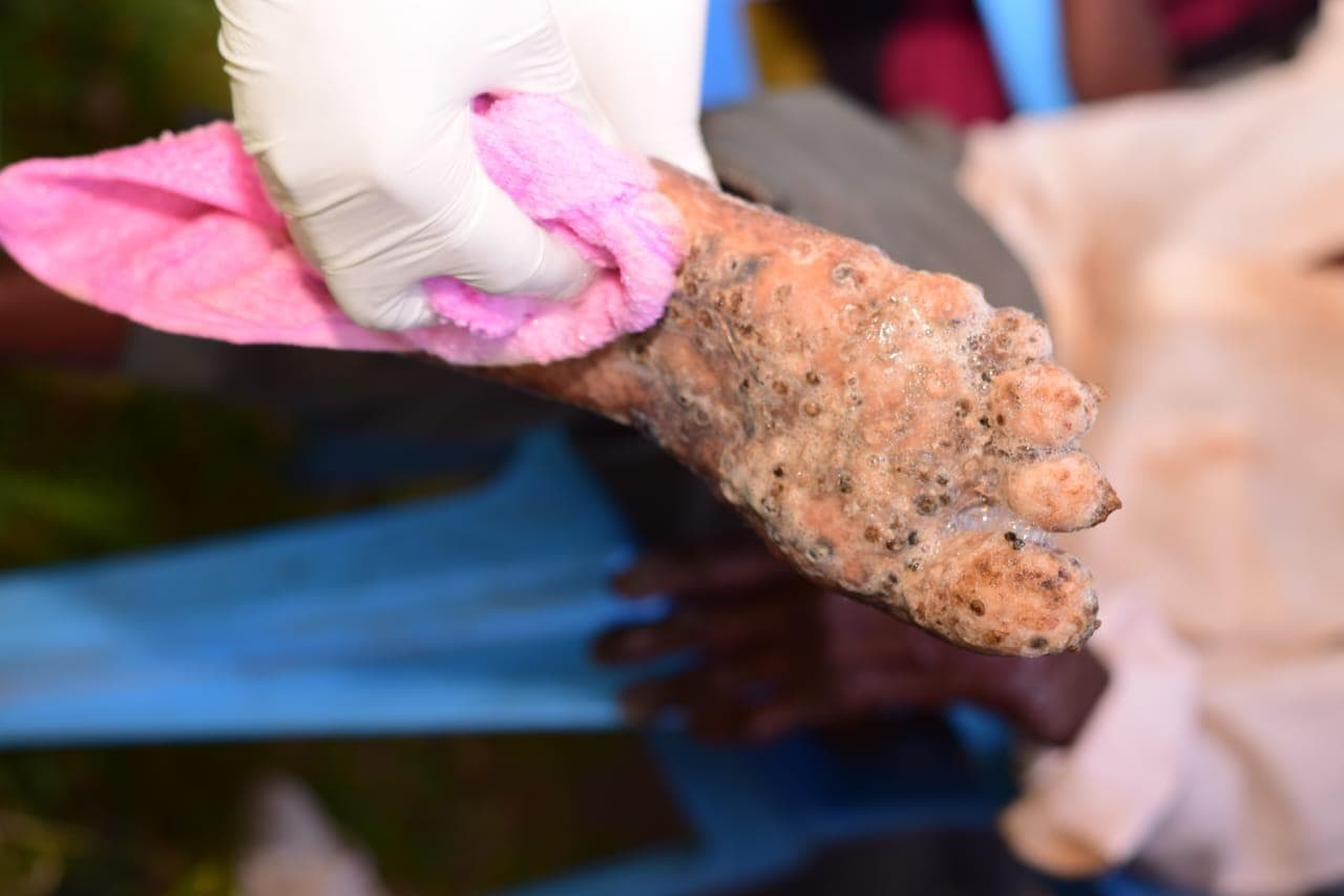 jigger-infested feet