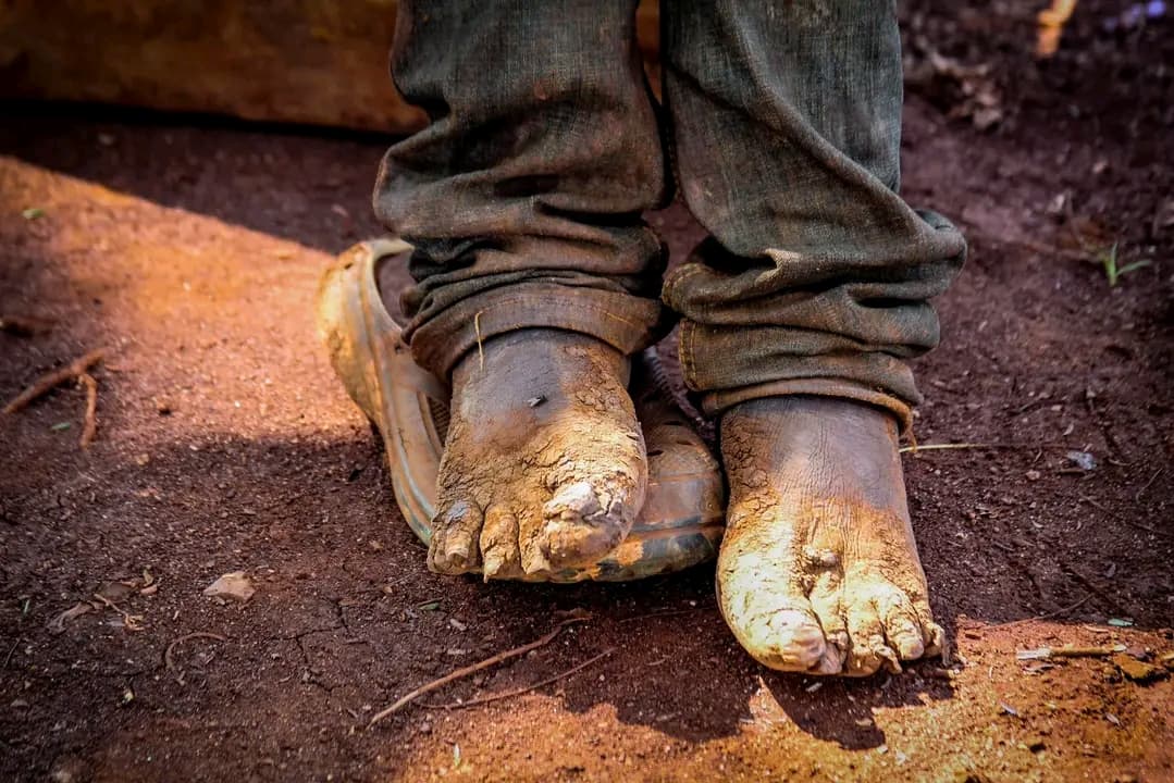 Feet affected by jigger infestation before treatment during a NALFA CBO health outreach in Siaya County, Kenya.