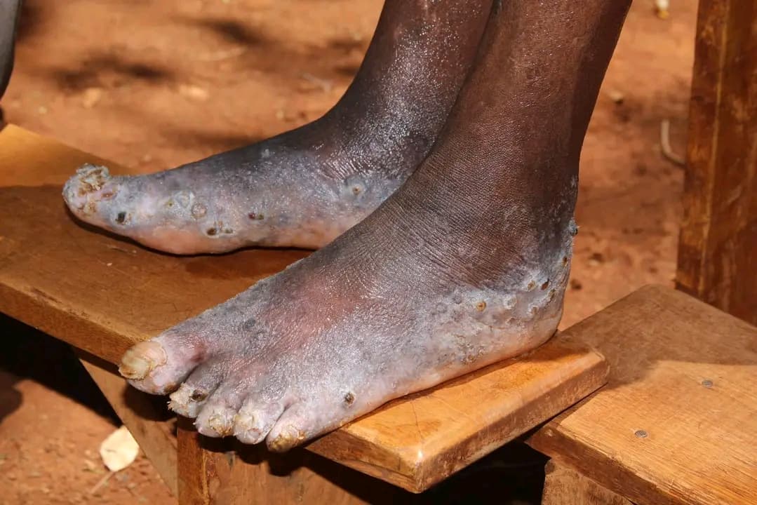 A close-up photo of cleaned feet prepared for jigger treatment during a NALFA CBO anti-jigger medical outreach in Siaya County, Kenya
