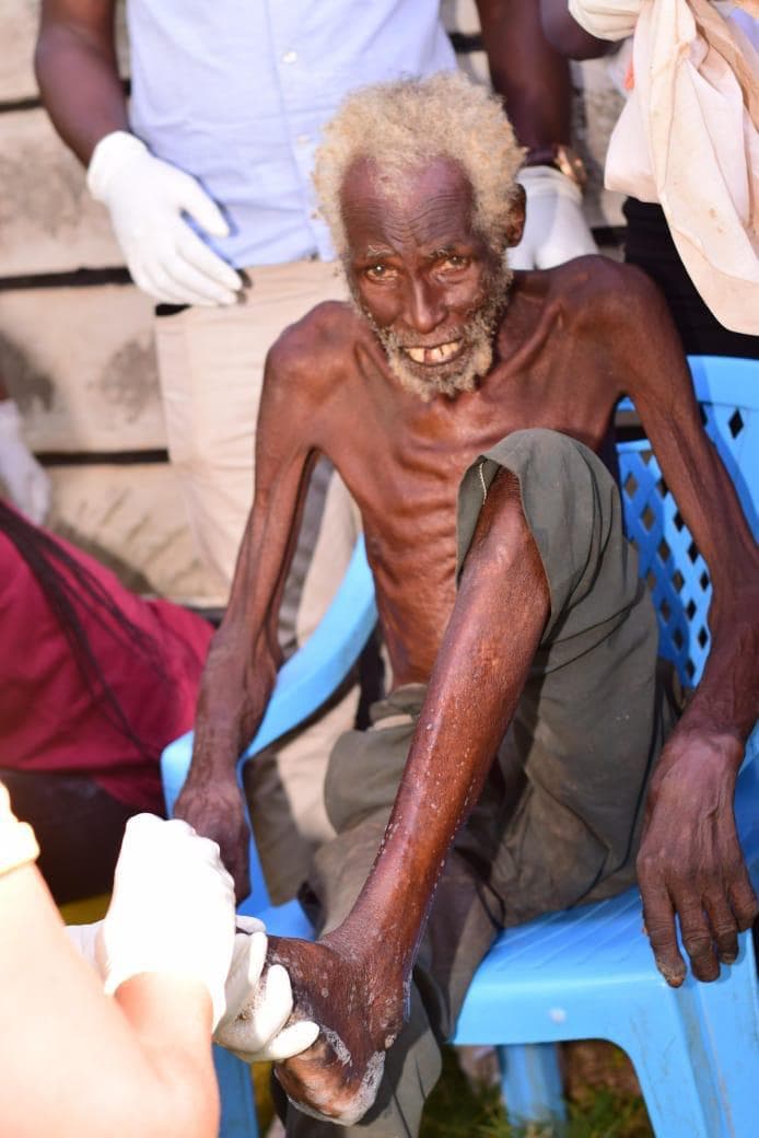 Restoring Dignity: Supporting an Elderly Man Living with Jiggers in Ndere Komollo, Siaya County