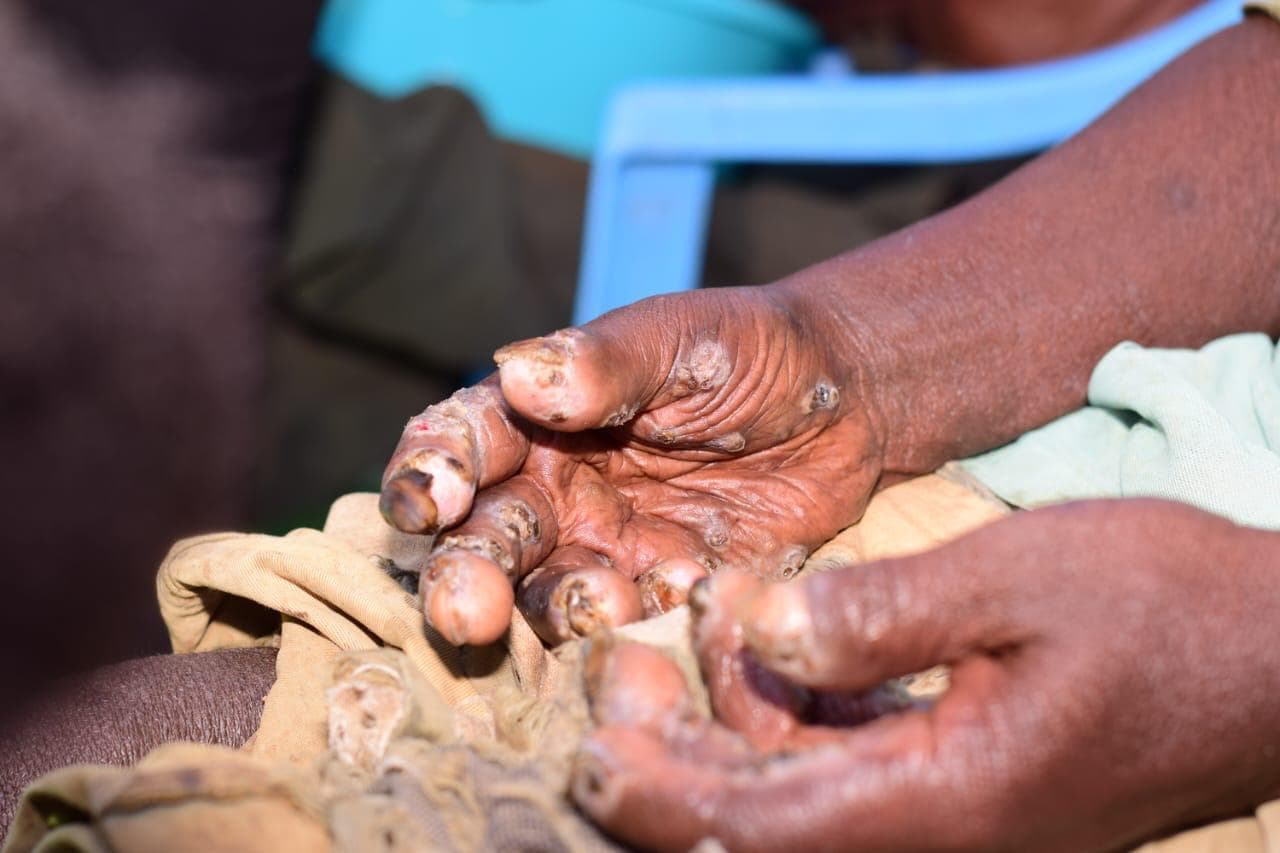 Hope Beyond Jiggers Initiative 2026